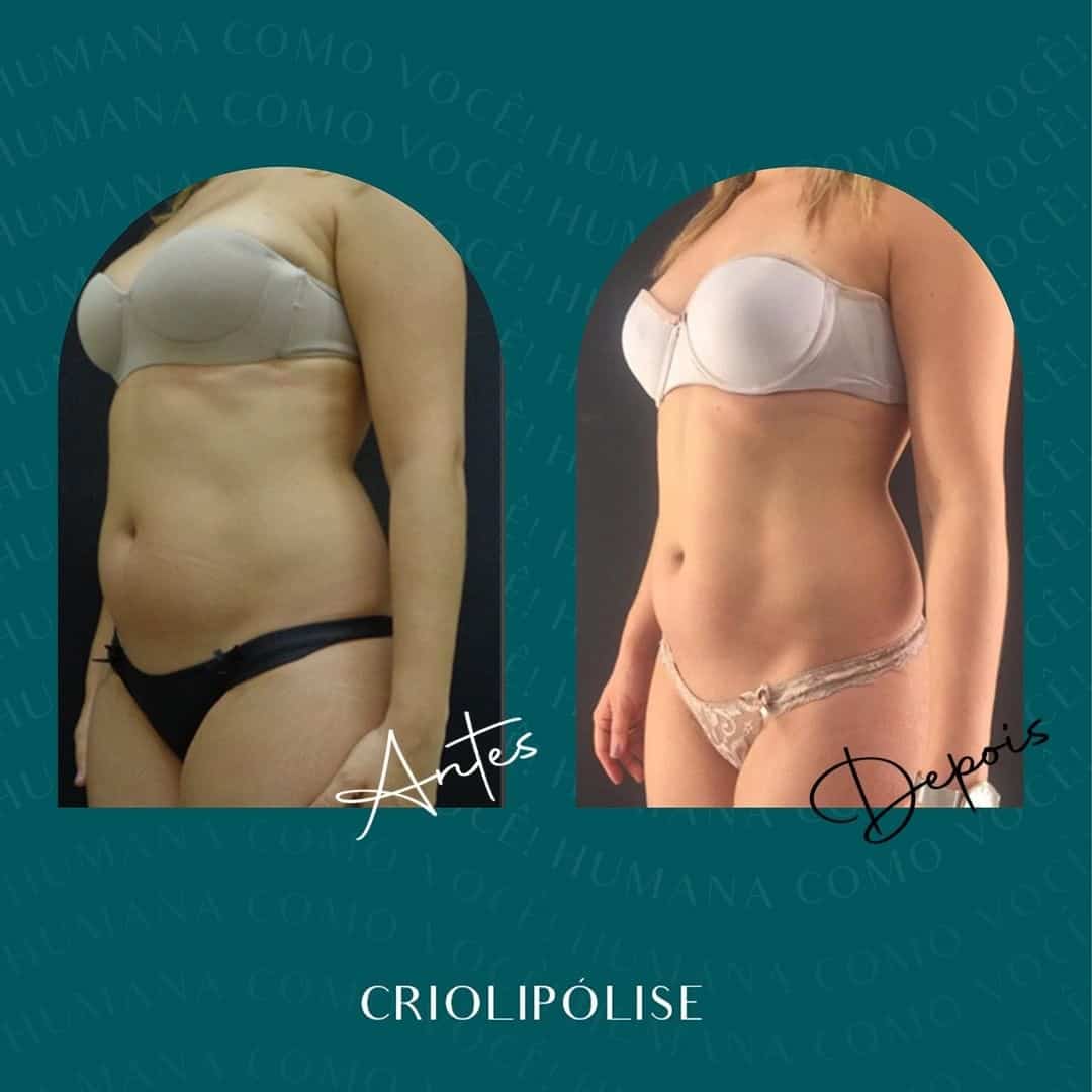 Criolipolise Aprimori Clinica Estética em BH